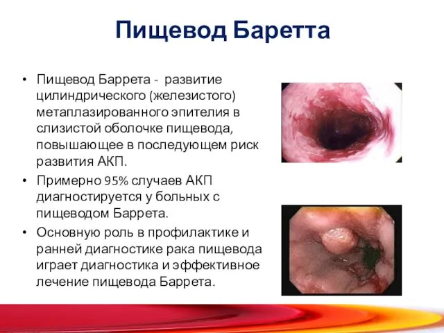 Пищевод Баретта Пищевод Баррета - развитие цилиндрического (железистого) метаплазированного эпителия в