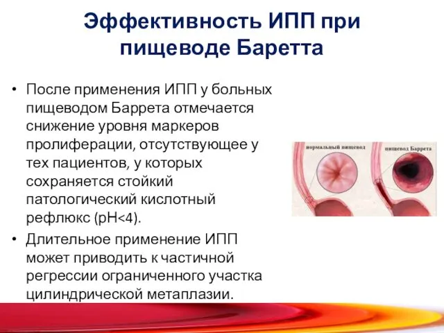 Эффективность ИПП при пищеводе Баретта После применения ИПП у больных пищеводом