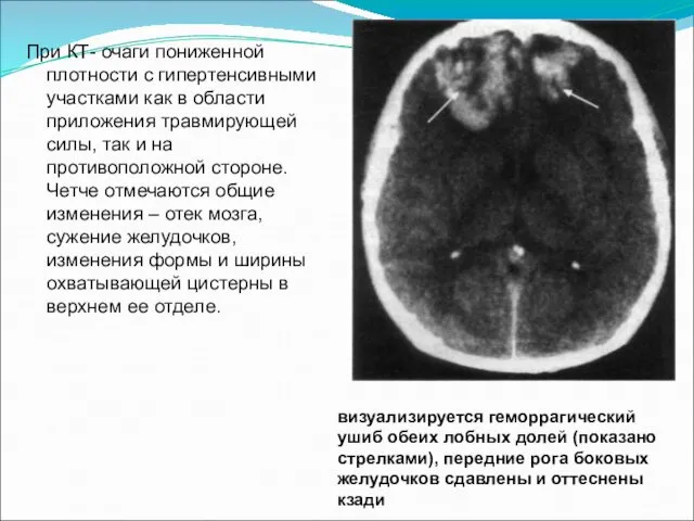 При КТ- очаги пониженной плотности с гипертенсивными участками как в области