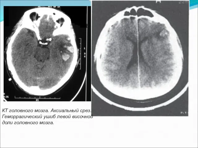 КТ головного мозга. Аксиальный срез. Геморрагический ушиб левой височной доли головного мозга.