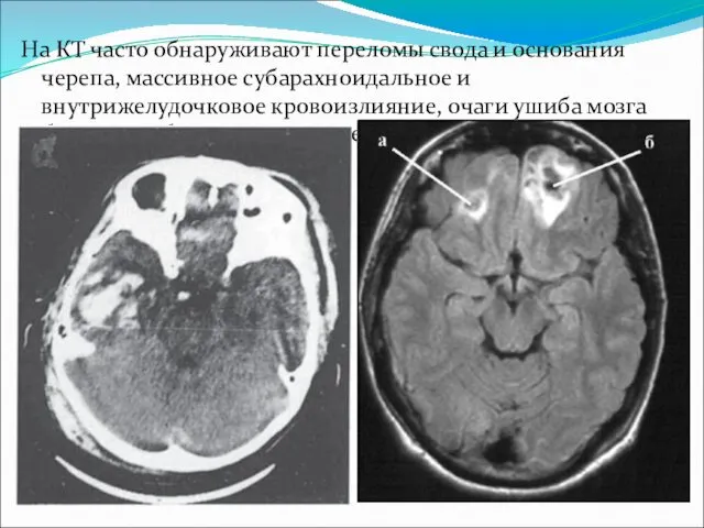 На КТ часто обнаруживают переломы свода и основания черепа, массивное субарахноидальное