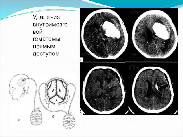 Удаление внутримозговой гематомы прямым доступом