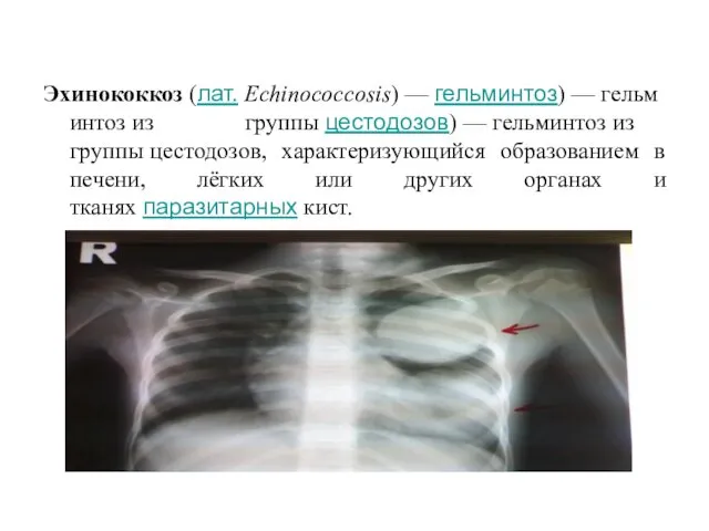 Эхинококкоз (лат. Echinococcosis) — гельминтоз) — гельминтоз из группы цестодозов) —