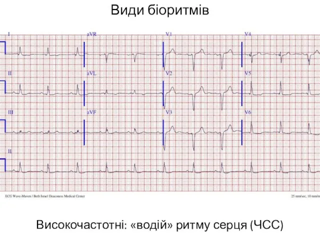 Види біоритмів Високочастотні: «водій» ритму серця (ЧСС)