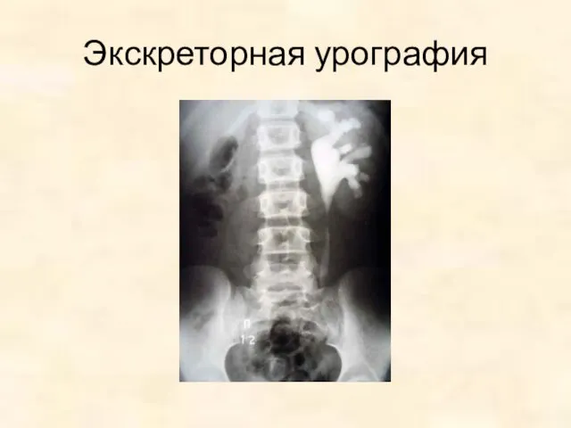 Экскреторная урография