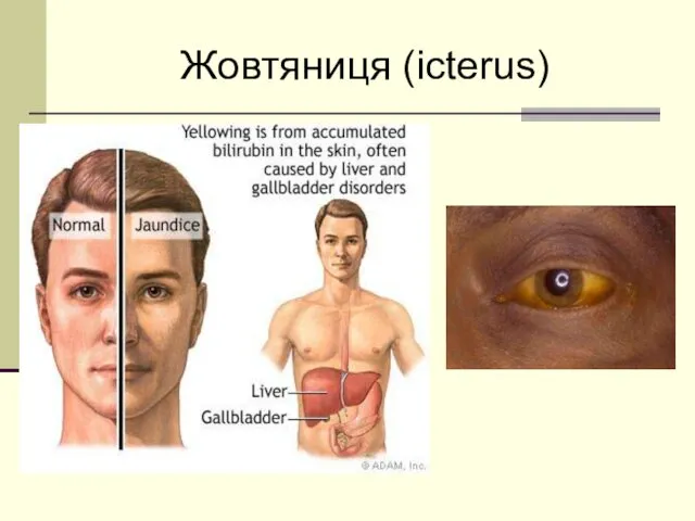 Жовтяниця (icterus)