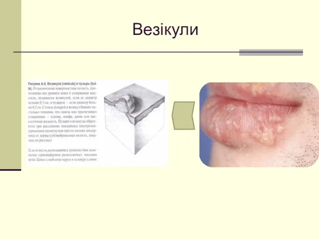 Везікули