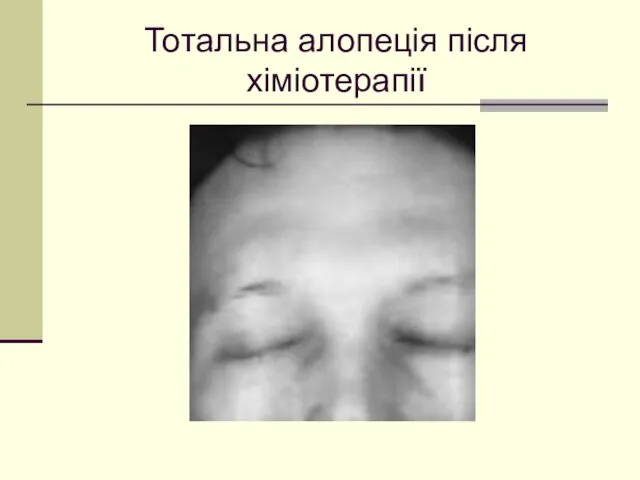 Тотальна алопеція після хіміотерапії