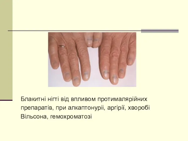 Блакитні нігті від впливом протималярійних препаратів, при алкаптонуріі, аргірії, хворобі Вільсона, гемохроматозі