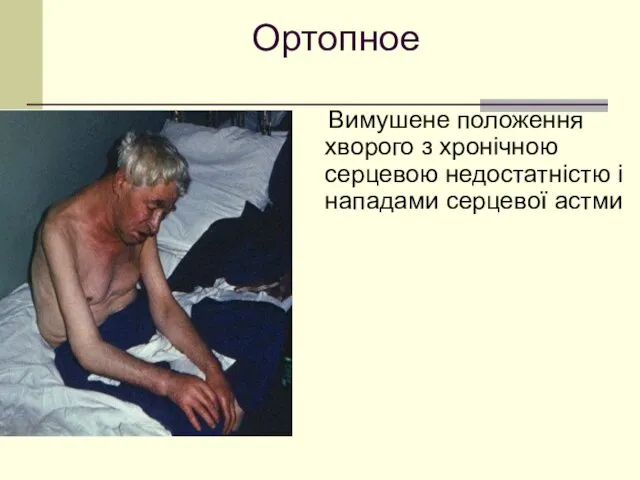 Ортопное Вимушене положення хворого з хронічною серцевою недостатністю і нападами серцевої астми