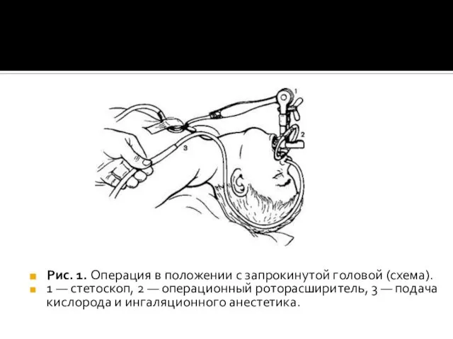 Рис. 1. Операция в положении с запрокинутой головой (схема). 1 —