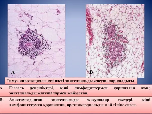 Анастамозданған эпителиальды жасушалар тәждері, кіші лимфоциттермен қоршалған, преэпикардиальды май тініне енген.