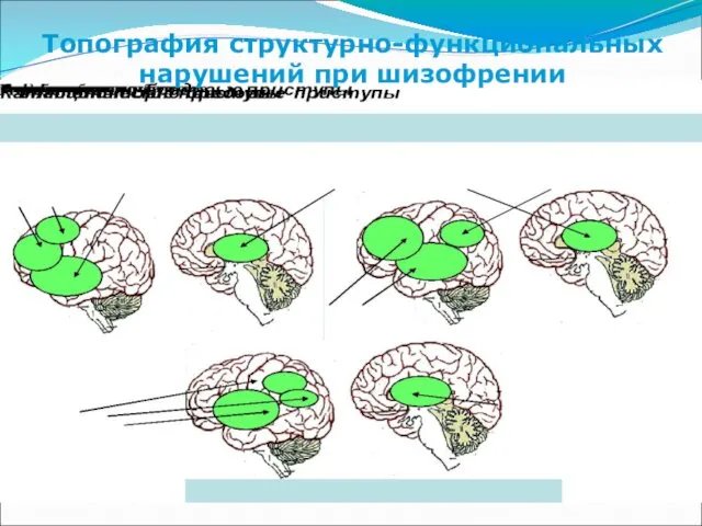 Топография структурно-функциональных нарушений при шизофрении