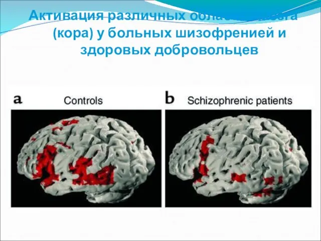 Активация различных областей мозга (кора) у больных шизофренией и здоровых добровольцев
