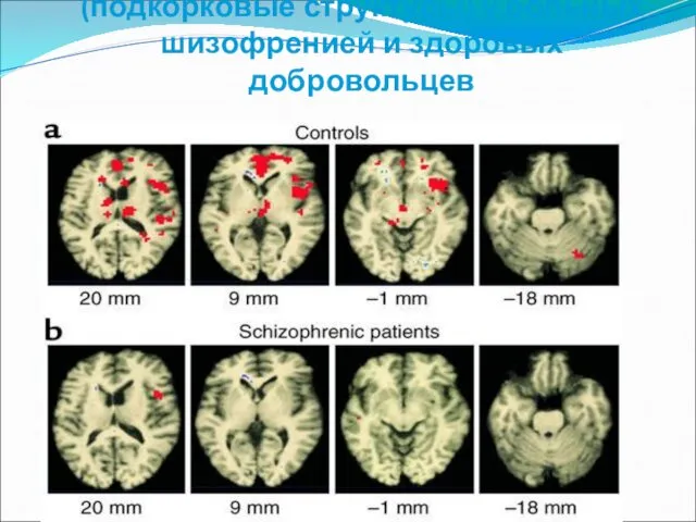 Активация различных областей мозга (подкорковые структуры) у больных шизофренией и здоровых добровольцев