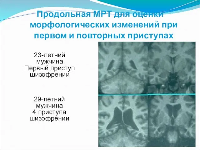 Продольная МРТ для оценки морфологических изменений при первом и повторных приступах