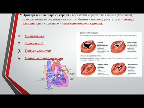 Приобретенные пороки сердца - поражения сердечного клапана (клапанов), створки которого оказываются