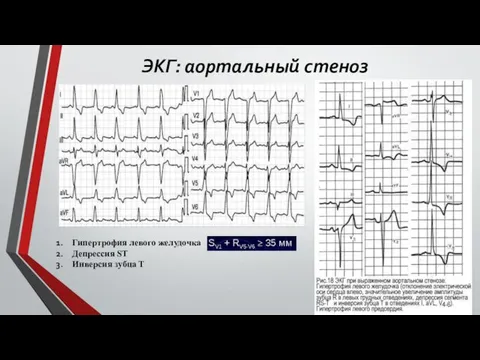 ЭКГ: аортальный стеноз Гипертрофия левого желудочка Депрессия ST Инверсия зубца Т