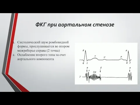 ФКГ при аортальном стенозе Систолический шум ромбовидной формы, прослушивается во втором