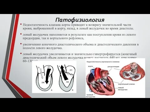 Патофизиология Недостаточность клапана аорты приводит к возврату значительной части крови, выброшенной