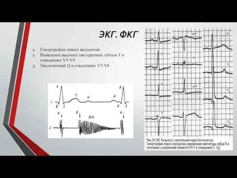 ЭКГ. ФКГ Гипертрофия левого желудочка Появление высоких заостренных зубцов Т в