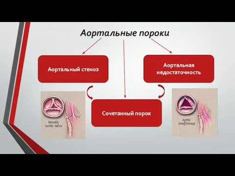 Аортальные пороки Аортальный стеноз Аортальная недостаточность Сочетанный порок