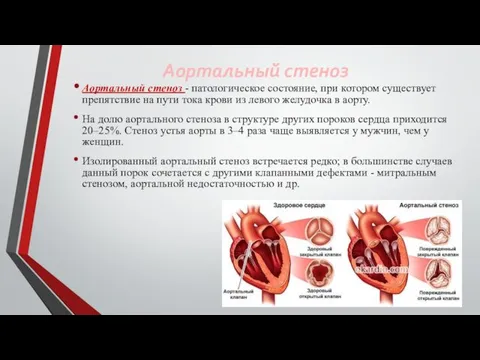 Аортальный стеноз Аортальный стеноз - патологическое состояние, при котором существует препятствие