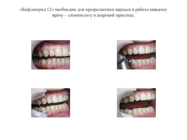 «Бифлюорид 12» необходим для профилактики кариеса в работе каждому врачу – стоматологу в широкой практике.