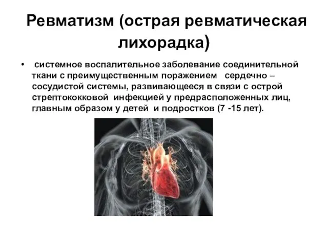 Ревматизм (острая ревматическая лихорадка) системное воспалительное заболевание соединительной ткани с преимущественным