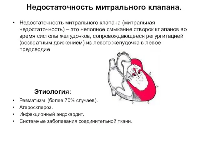 Недостаточность митрального клапана. Недостаточность митрального клапана (митральная недостаточность) – это неполное