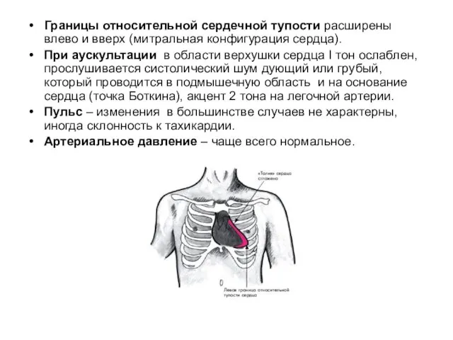 Границы относительной сердечной тупости расширены влево и вверх (митральная конфигурация сердца).