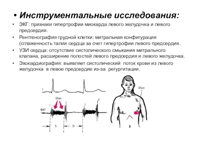 Инструментальные исследования: ЭКГ: признаки гипертрофии миокарда левого желудочка и левого предсердия.