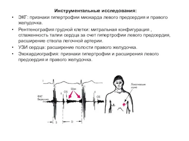 Инструментальные исследования: ЭКГ: признаки гипертрофии миокарда левого предсердия и правого желудочка.