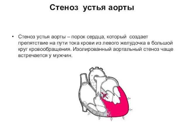 Стеноз устья аорты Стеноз устья аорты – порок сердца, который создает