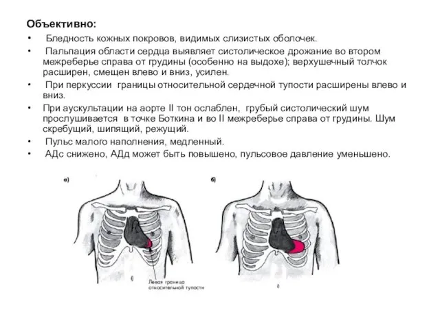 Объективно: Бледность кожных покровов, видимых слизистых оболочек. Пальпация области сердца выявляет