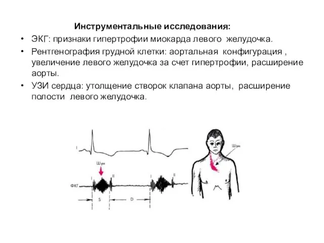 Инструментальные исследования: ЭКГ: признаки гипертрофии миокарда левого желудочка. Рентгенография грудной клетки: