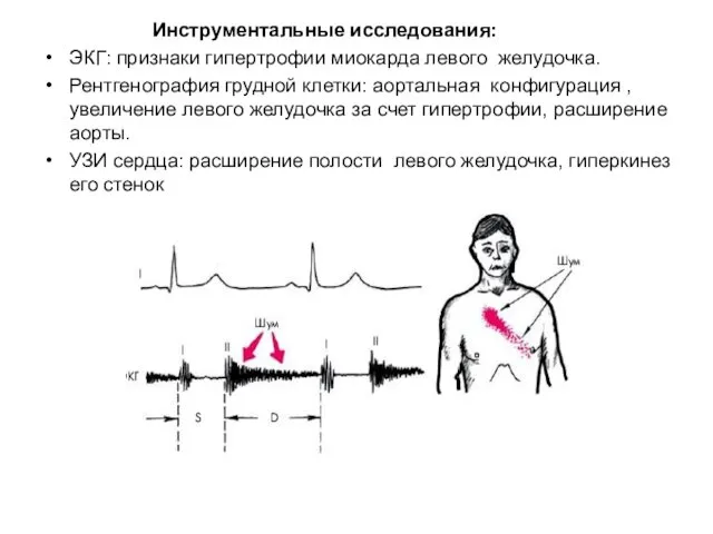Инструментальные исследования: ЭКГ: признаки гипертрофии миокарда левого желудочка. Рентгенография грудной клетки: