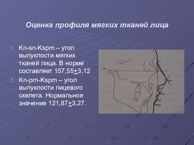 Оценка профиля мягких тканей лица Kn-sn-Kspm – угол выпуклости мягких тканей