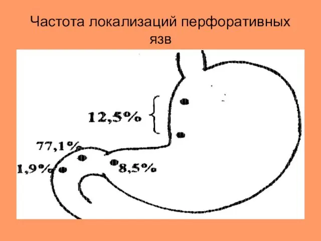 Частота локализаций перфоративных язв