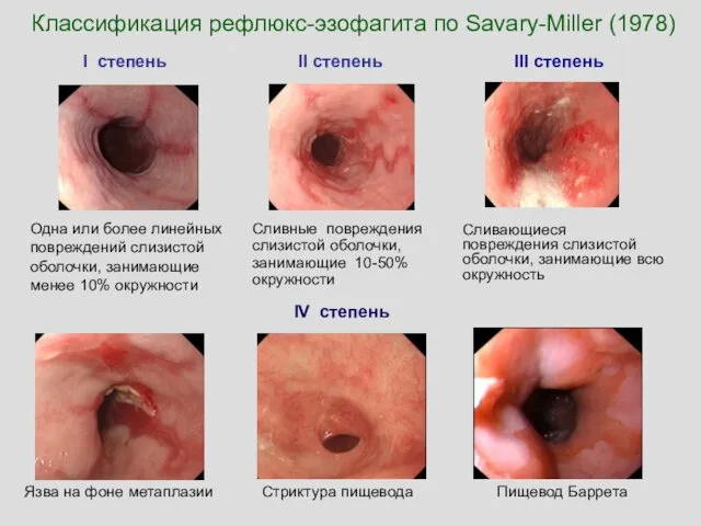IV степень Язва на фоне метаплазии Стриктура пищевода Пищевод Баррета Классификация