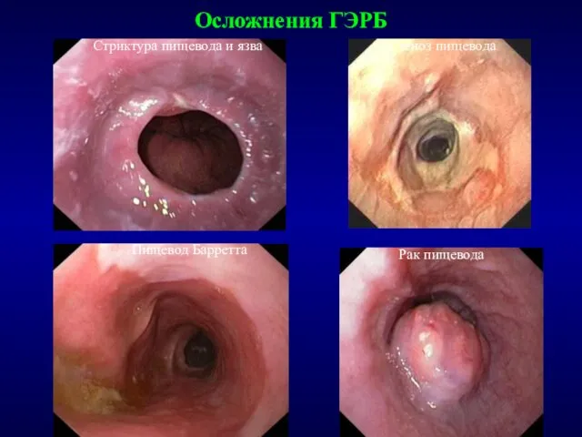 Осложнения ГЭРБ Стриктура пищевода и язва Стеноз пищевода Пищевод Барретта Рак пищевода
