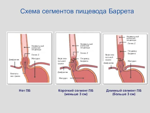 Нормальный эпителий пищевода Линия Z Желудок Диафрагма Хиаталь-ная грыжа Нормальный эпителий