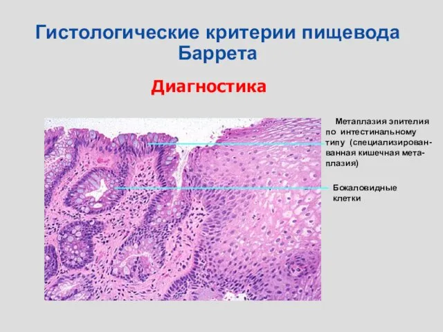 Диагностика Гистологические критерии пищевода Баррета Метаплазия эпителия по интестинальному типу (специализирован-