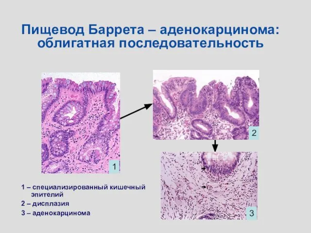 Пищевод Баррета – аденокарцинома: облигатная последовательность 1 2 3 1 –