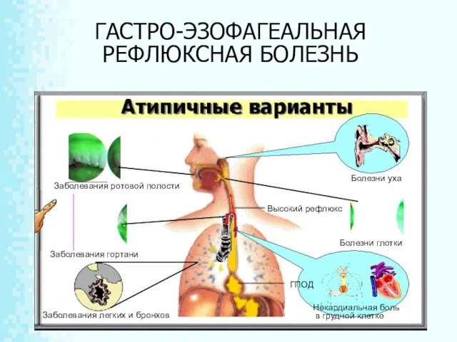 ГАСТРО-ЭЗОФАГЕАЛЬНАЯ РЕФЛЮКСНАЯ БОЛЕЗНЬ Заболевания ротовой полости Заболевания гортани Болезни уха Болезни