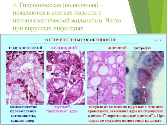 3. Гидропическая (водяночная) – появляются в клетках полости с цитоплазматической жидкостью. Часто при вирусных инфекциях