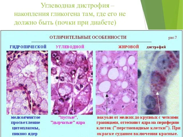 Углеводная дистрофия – накопления гликогена там, где его не должно быть (почки при диабете)