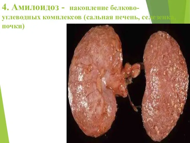 4. Амилоидоз - накопление белково-углеводных комплексов (сальная печень, селезенка, почки)