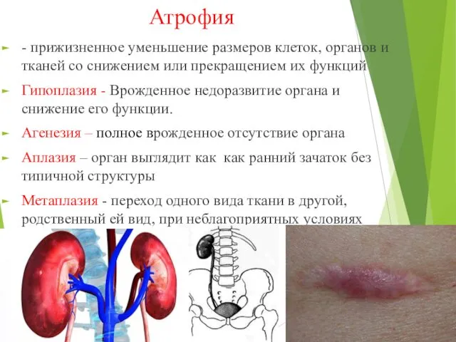 Атрофия - прижизненное уменьшение размеров клеток, органов и тканей со снижением