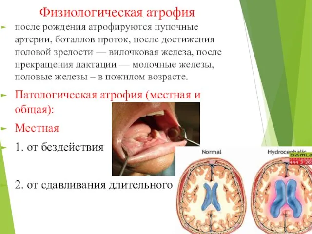 Физиологическая атрофия после рождения атрофируются пупочные артерии, боталлов проток, после достижения